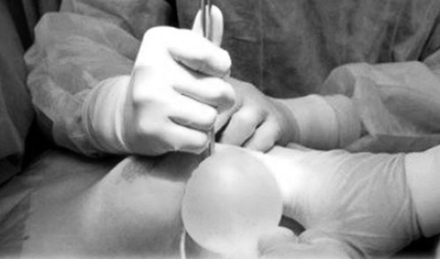 Biến dạng, nhiễm trùng nặng sau tiêm filler nâng ngực tại cơ sở “chui”